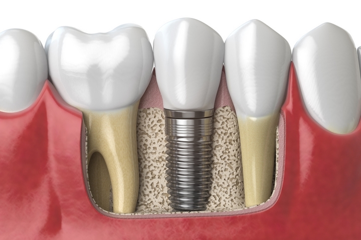 Dental-Implants-201807-002.jpg