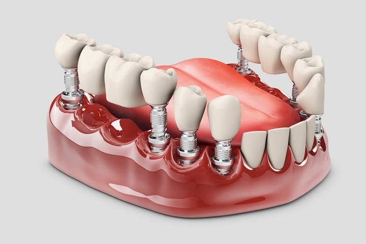 Dental-Implants-201810-002.jpg